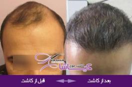 کاشت موی کیاشا