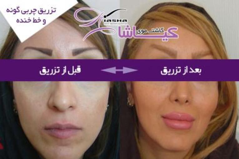 کاشت موی کیاشا