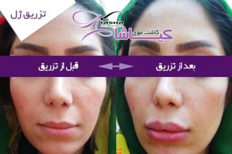 کاشت موی کیاشا
