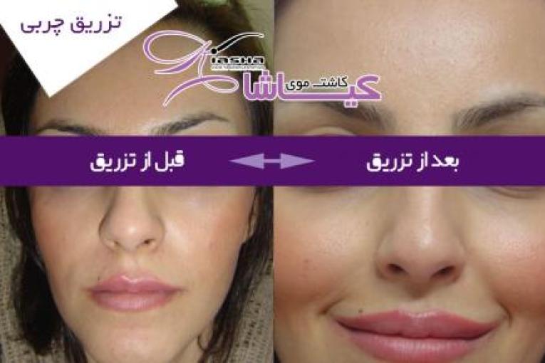 کاشت موی کیاشا