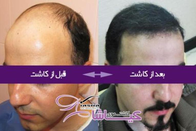 کاشت موی کیاشا