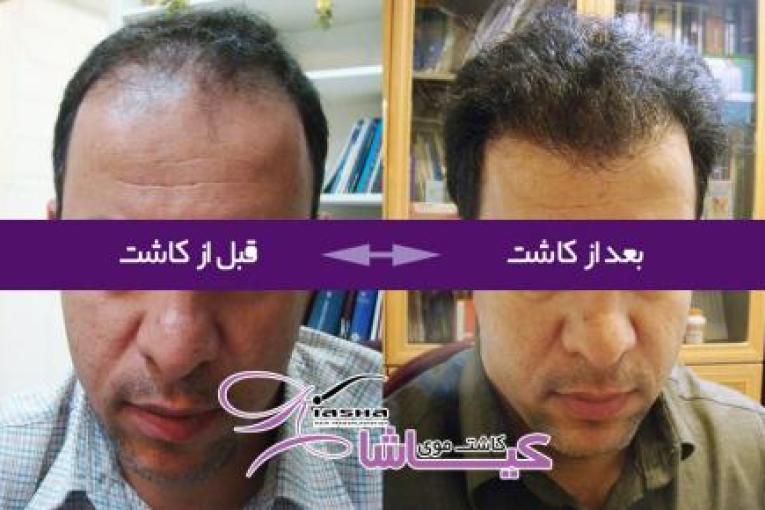 کاشت موی کیاشا