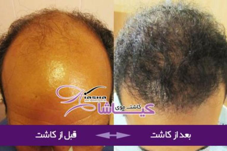 کاشت موی کیاشا